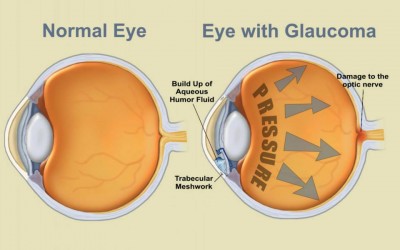 El Glaucoma