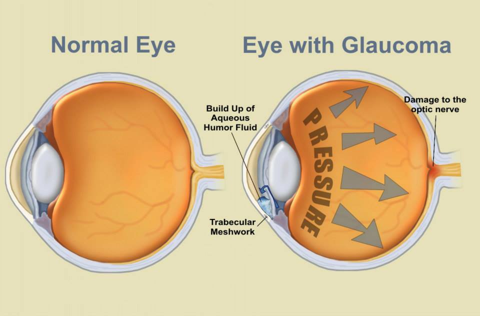 Ojo con Glaucoma