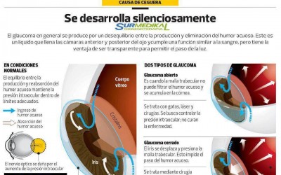 El Glaucoma se desarrolla silenciosamente
